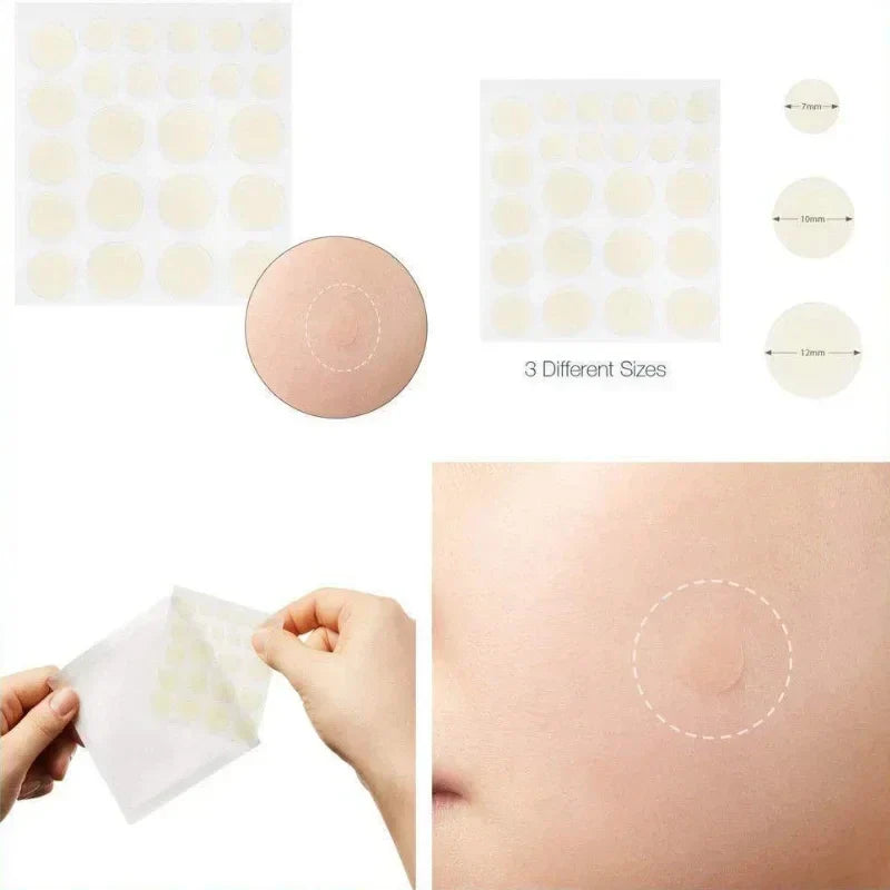 Acne Spot Treatment Patches