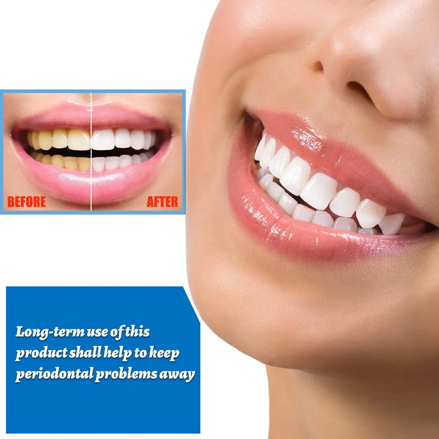 Tooth Whitening Removes Plaque Stains Tooth Bleaching Cleaning Whitening Teeth Oral Hygiene Tooth Whitening Prod