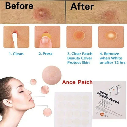 Acne Spot Treatment Patches
